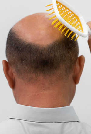 Hair Transplant